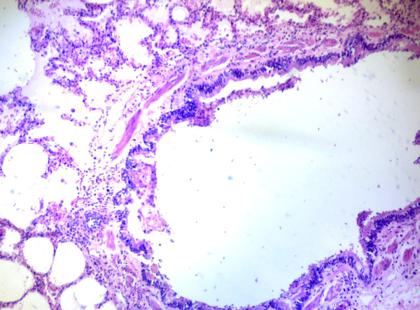 支氣管縱切(肺)